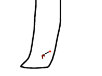 There's a pin in my shin